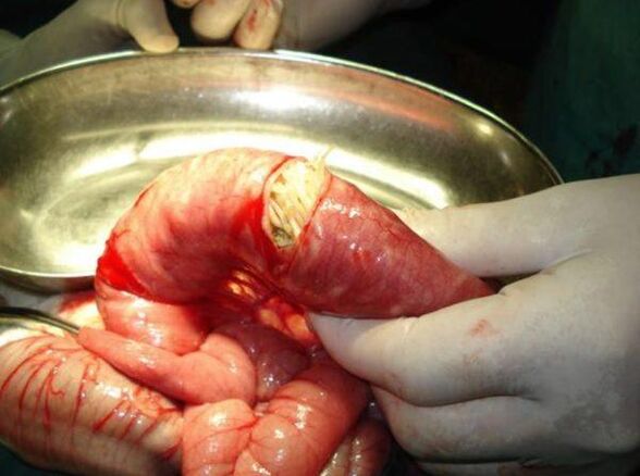 that worms are dangerous